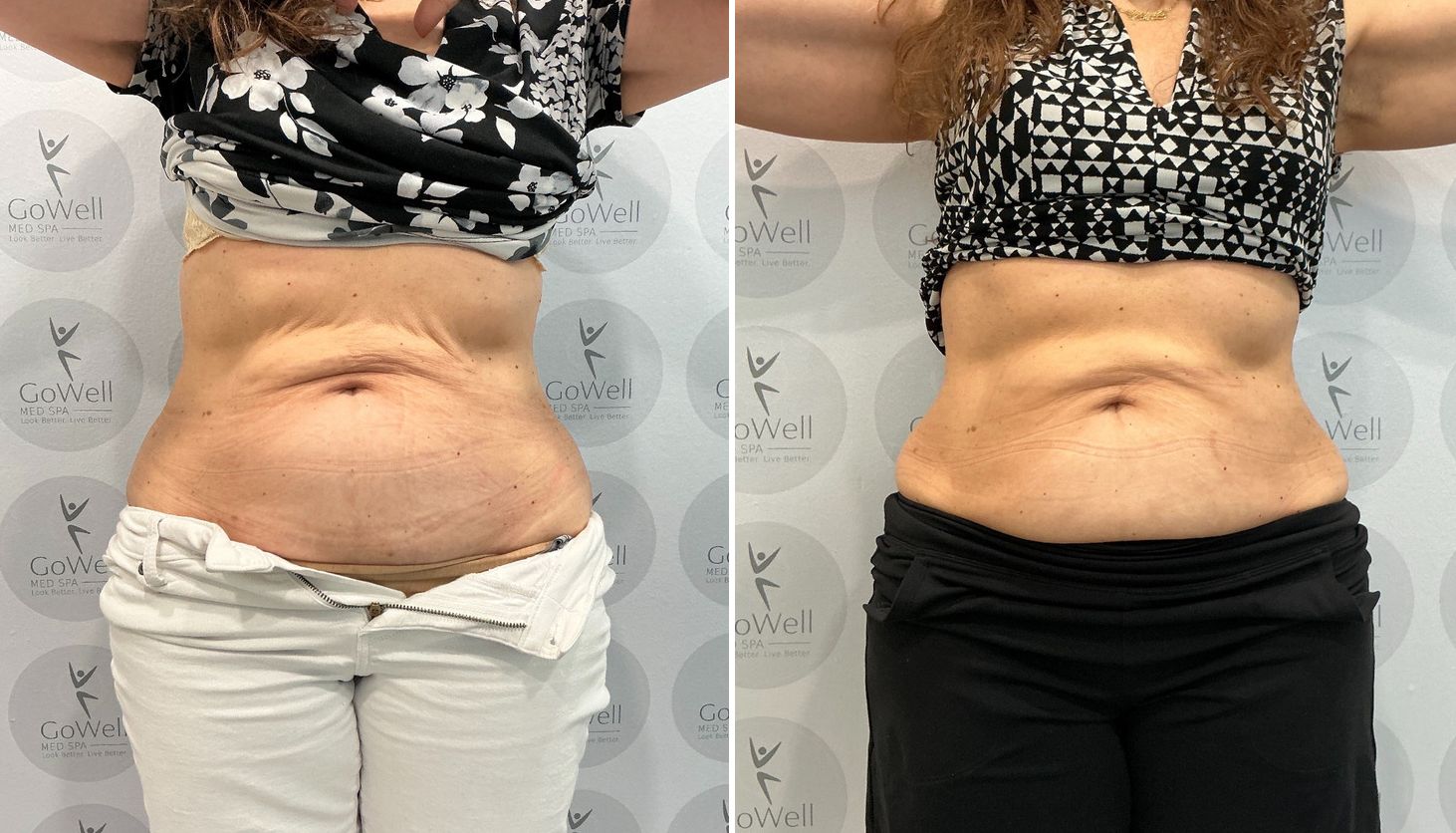 GoWell client before and after Venus Legacy on the abdomen and flanks