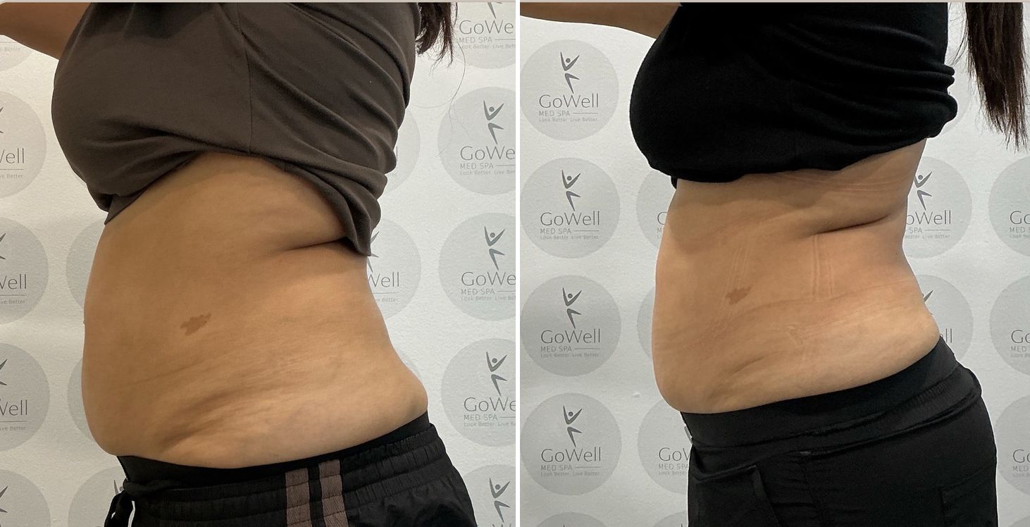 Abdomen and flanks — before and after