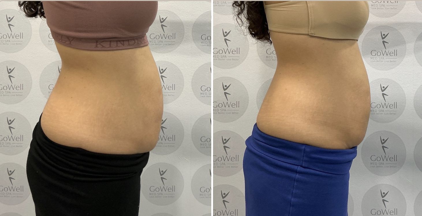Abdomen — before and after