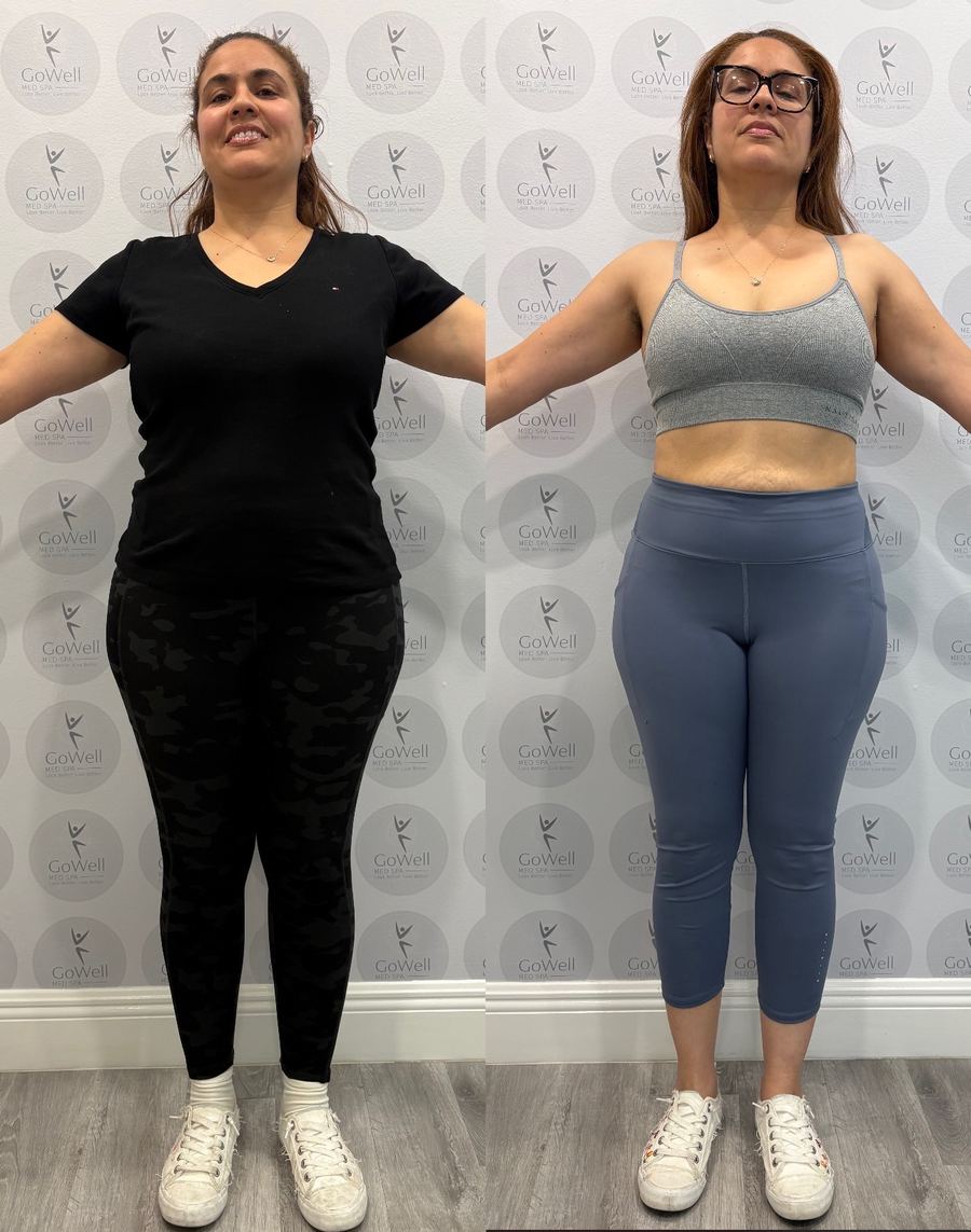 Before and after — front view