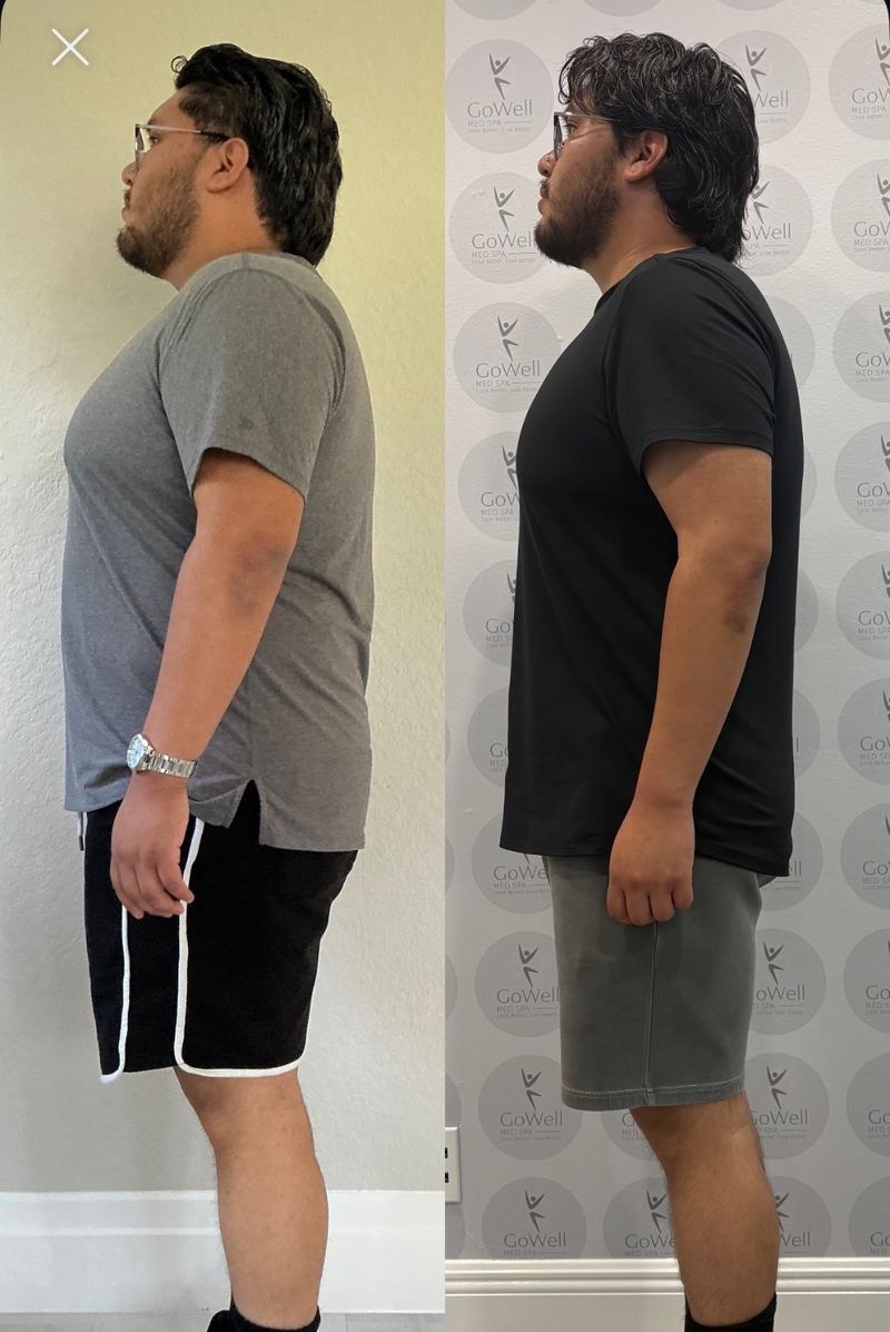 Before and after — side profile