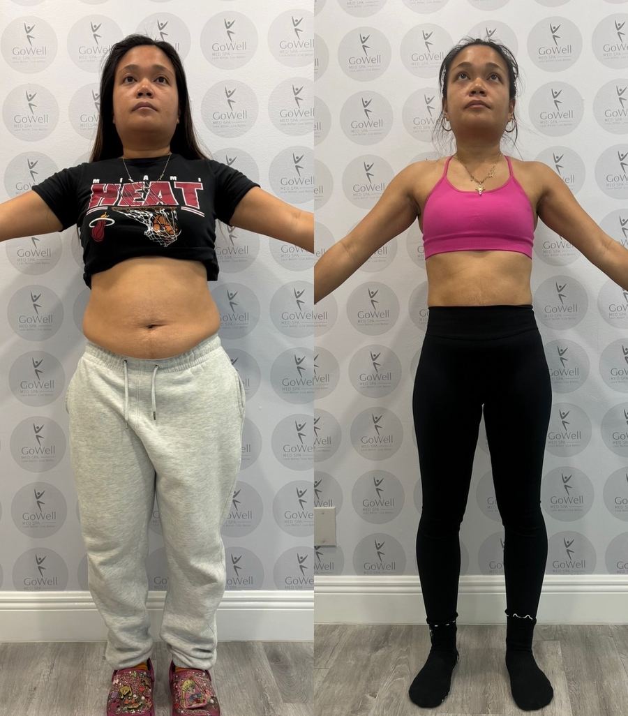 Before and after — front view