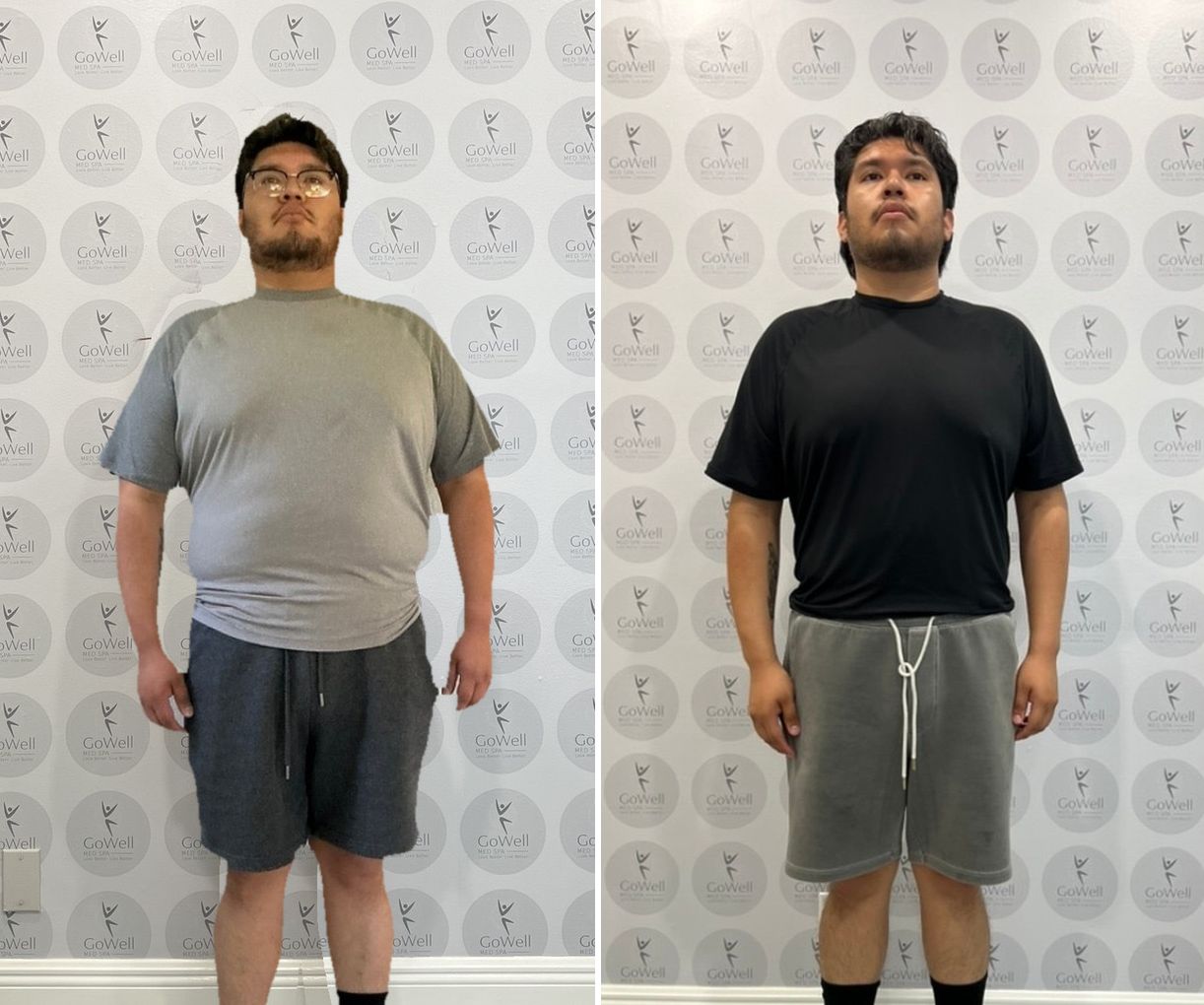 Before and after — front view