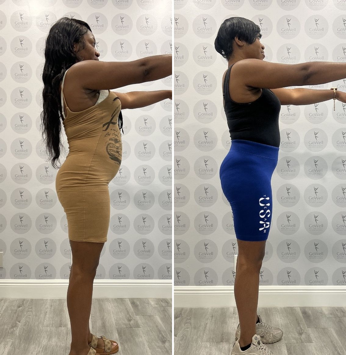 Before and after — side profile
